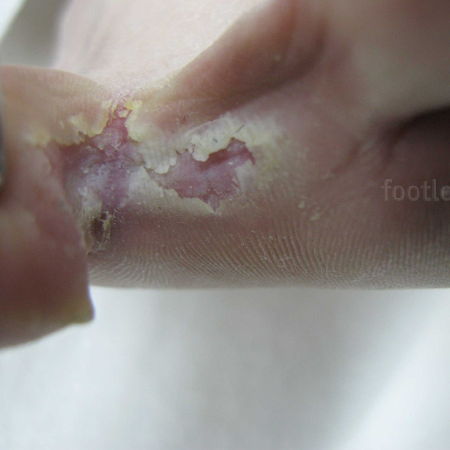 Footlogix Anti-Fungal Peeling Skin Formula