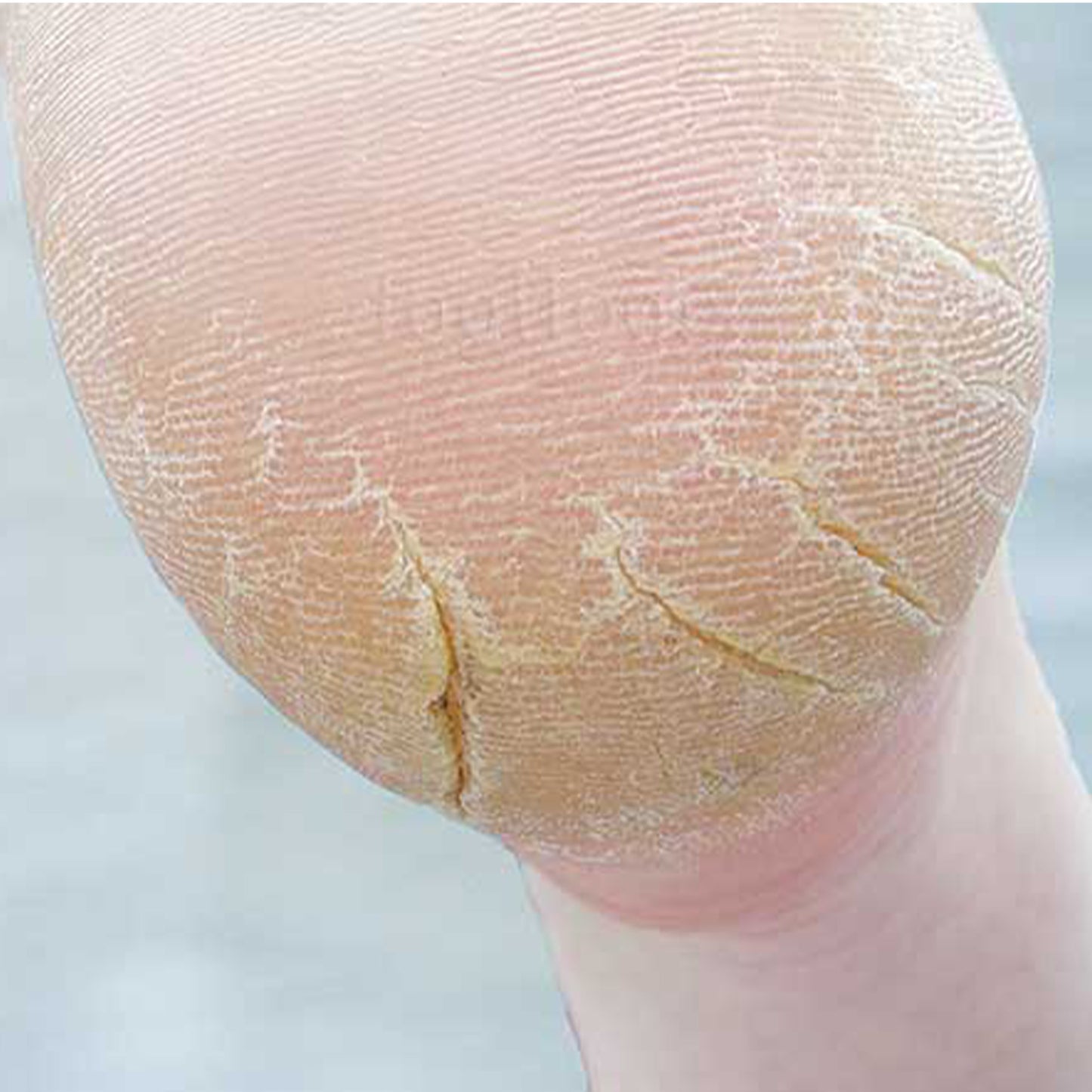 Footlogix Cracked Heel Formula - 50 ml / 4.23 oz.