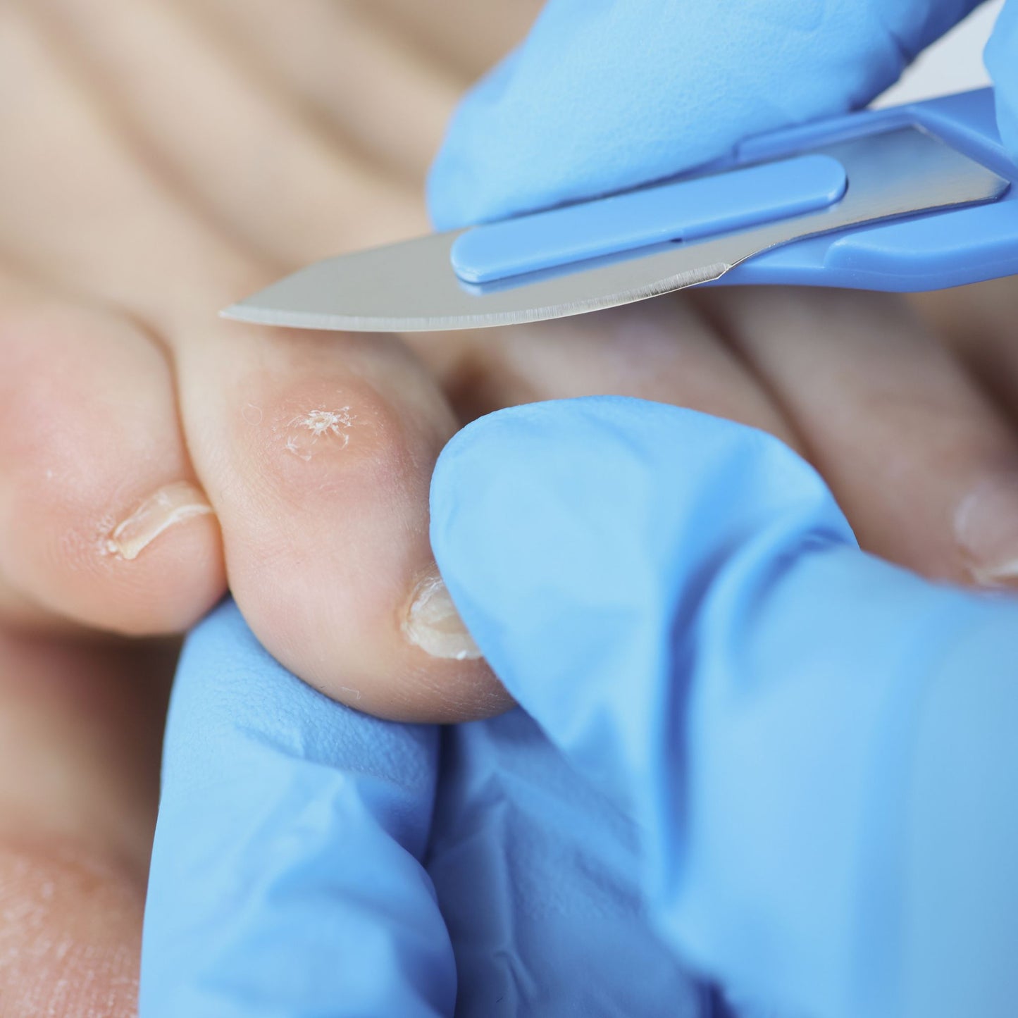 Pedicure verwijderd likdoorn op een teen met een scalpel