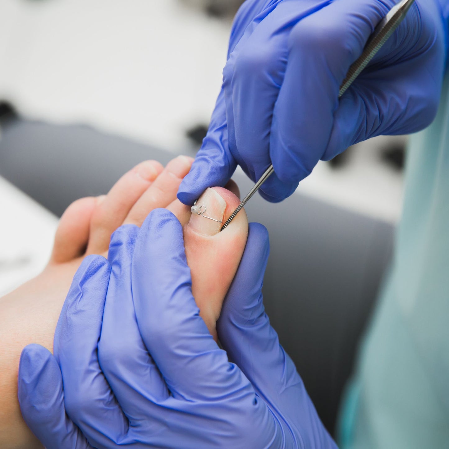 Pedicure plaatst een nagelbeugel